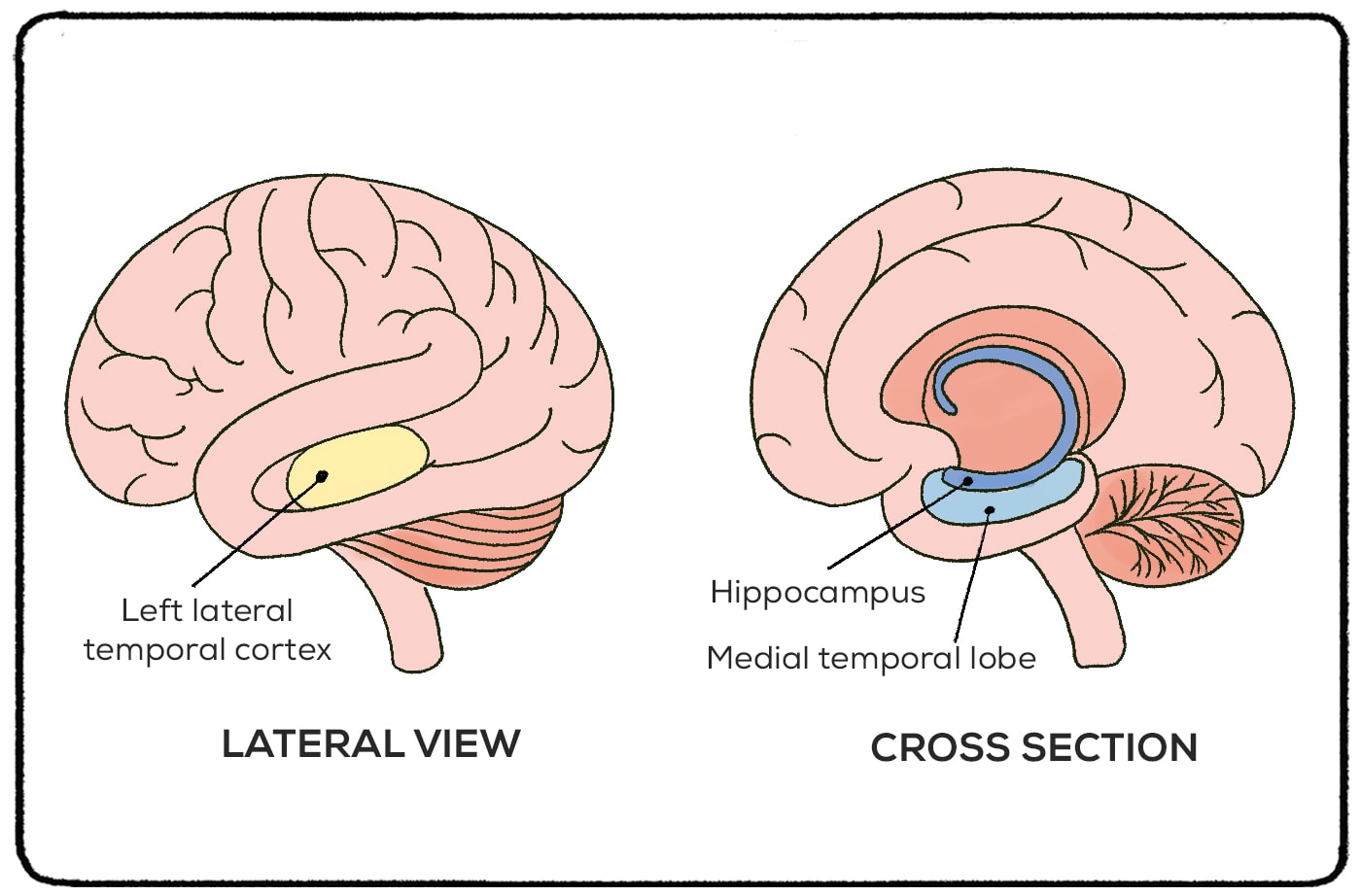 hippocampus and medial temporal lobes