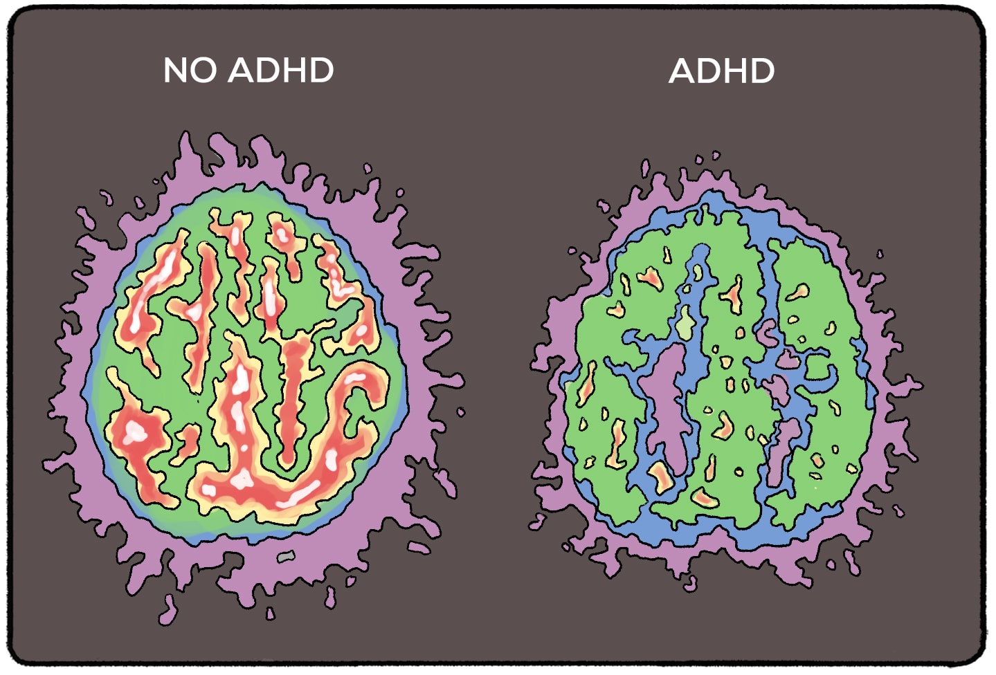 brain with ADHD vs brain without ADHD